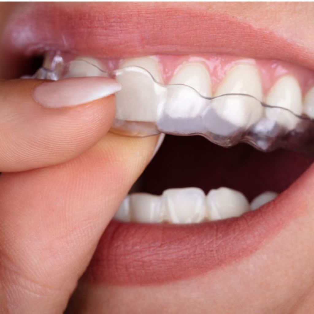 Invisible Teeth Aligners