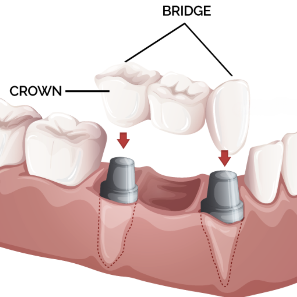 Zirconia & Ceramic Dental Crowns