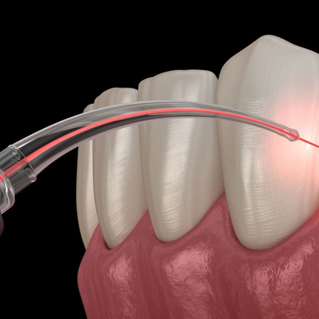Laser Gum Treatment & Periodontics
