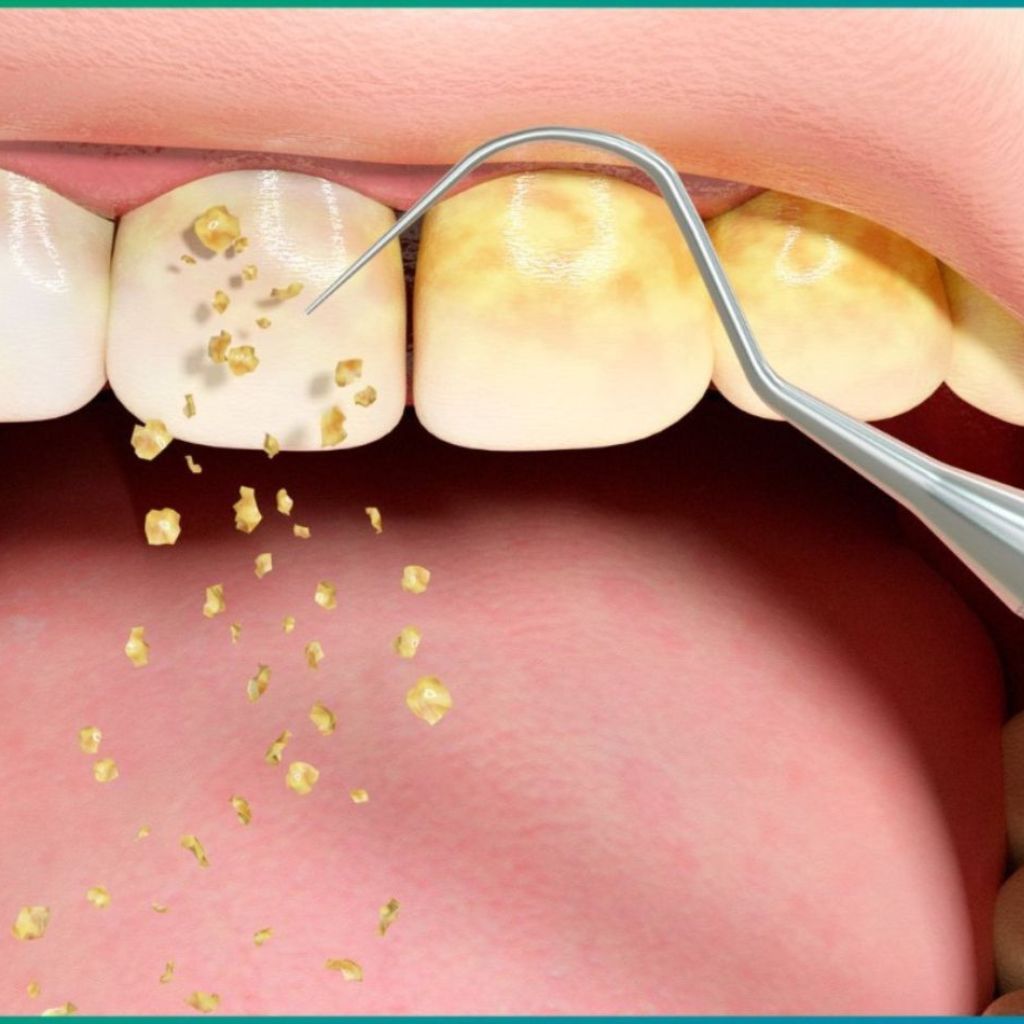 Ultrasonic Scaling & Teeth Polishing