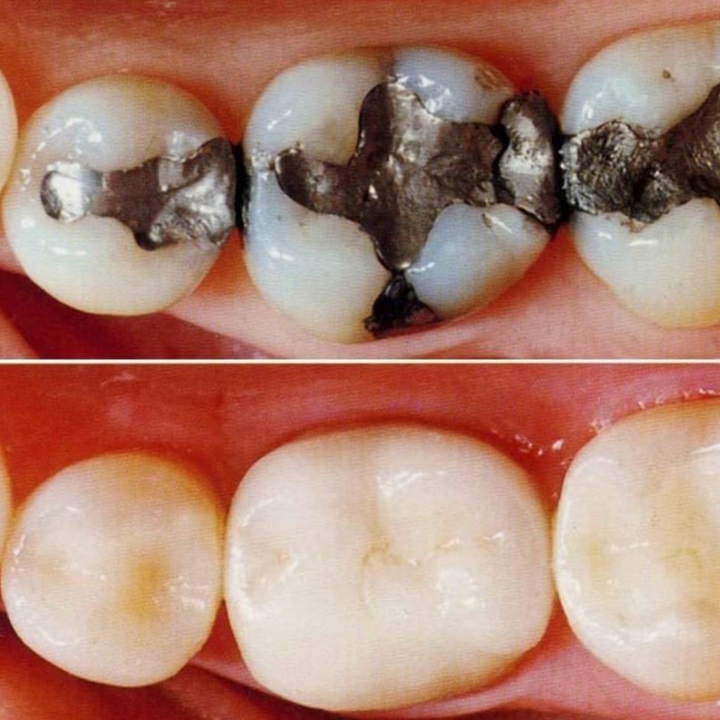 Tooth-Coloured Composite Fillings