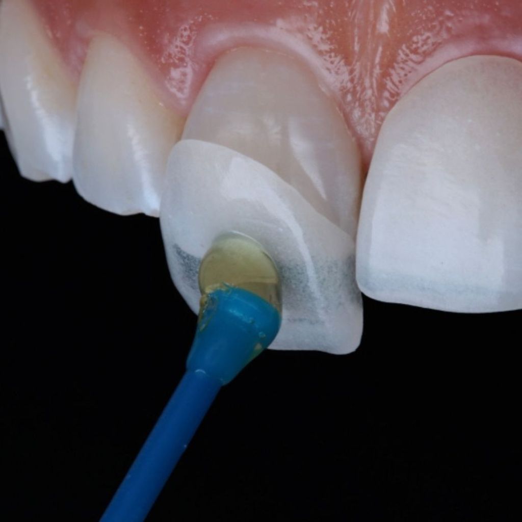 Porcelain Veneers & Smile Makeovers